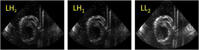 Cardiac Strain Imaging Using Multi-Perspective Ultrafast Ultrasound